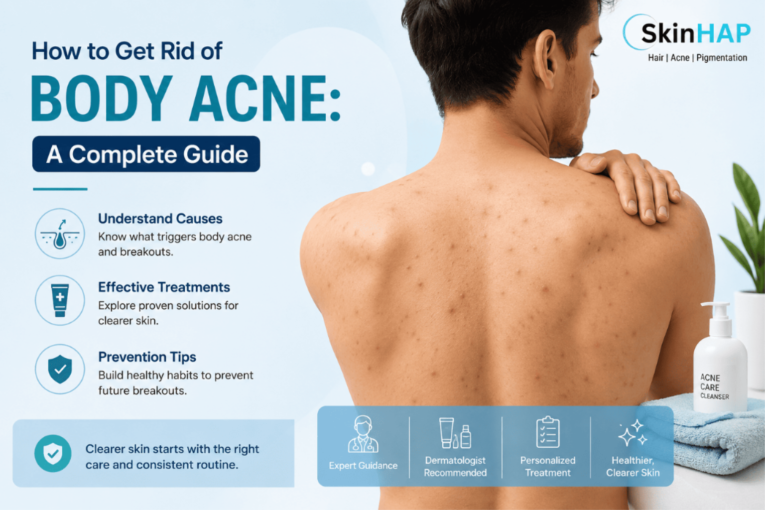 How to Get Rid of Body Acne: A Complete Guide 